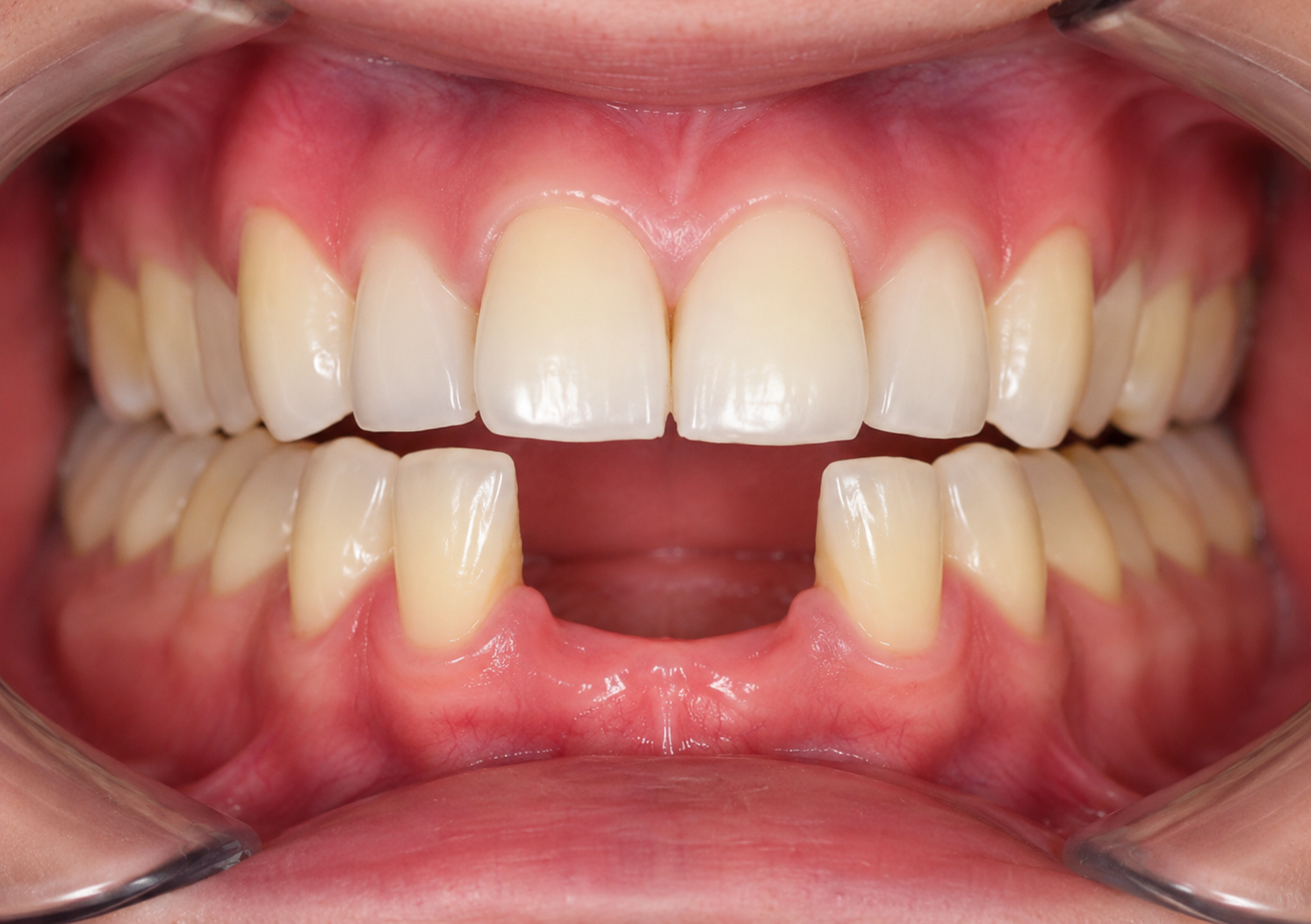 Implantes múltiples antes